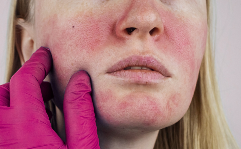 Rosácea: O Que É, Sintomas e Como Cuidar Corretamente da Pele