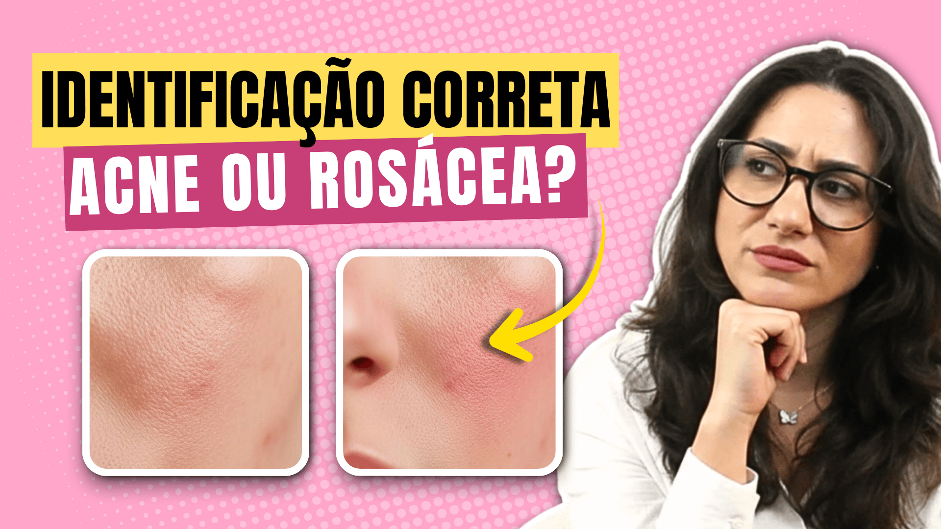 capa-acne-ou-rosacea2