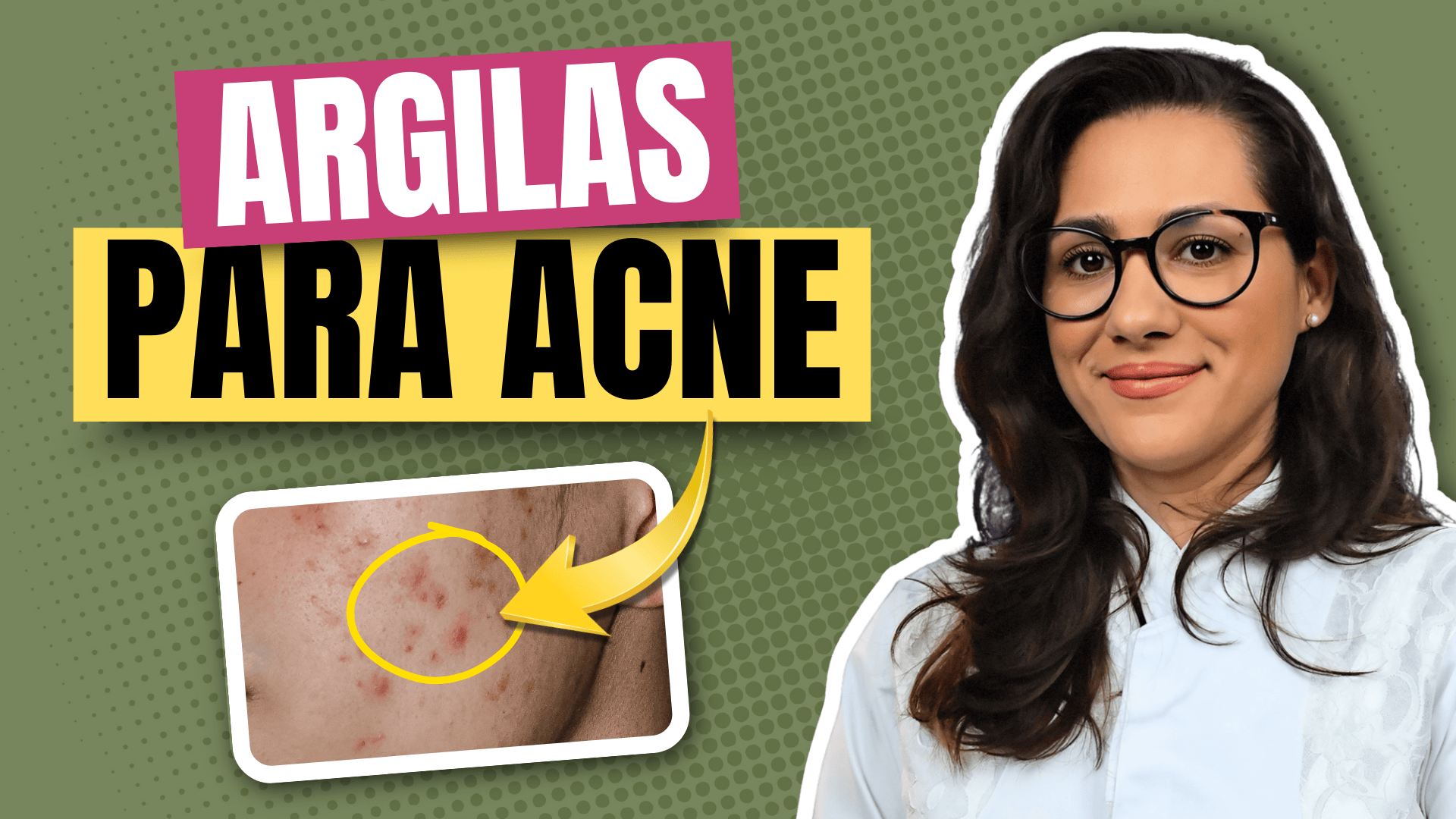 capa-argila-acne
