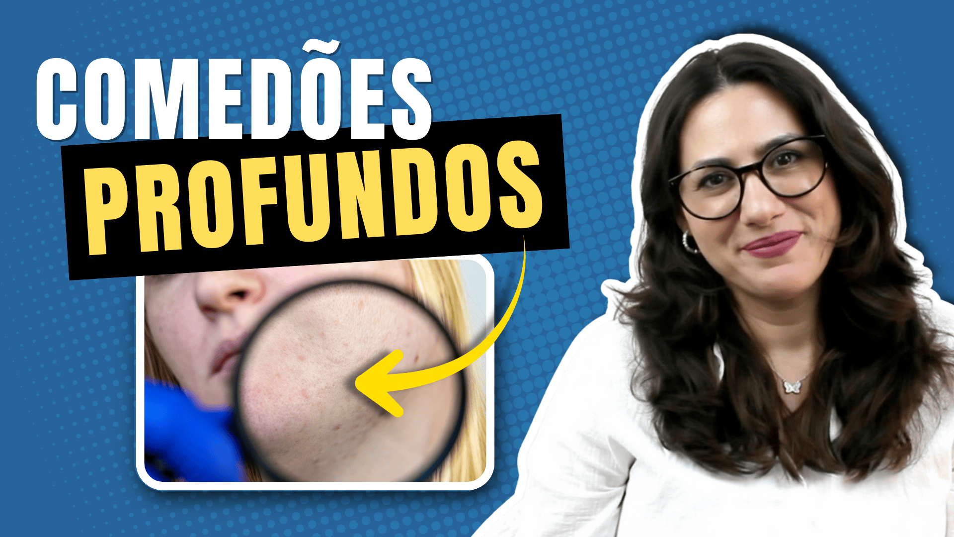 comedoes-profundos