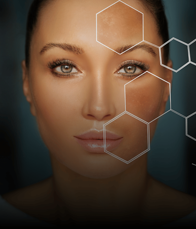 Melasma Controlado
